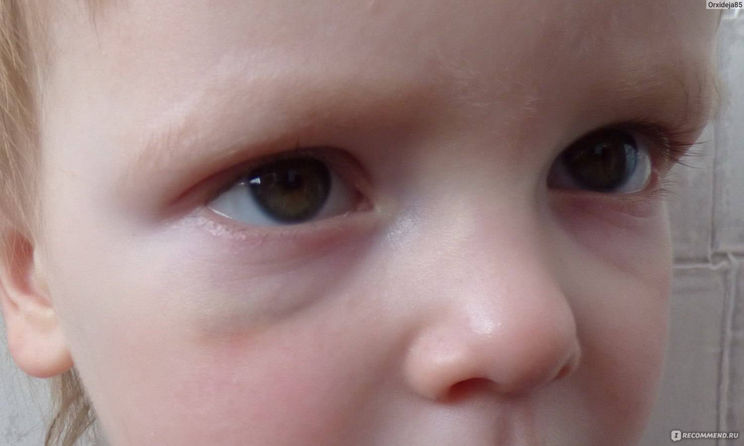 Круги под глазами у ребенка | eurolab | педиатрия
