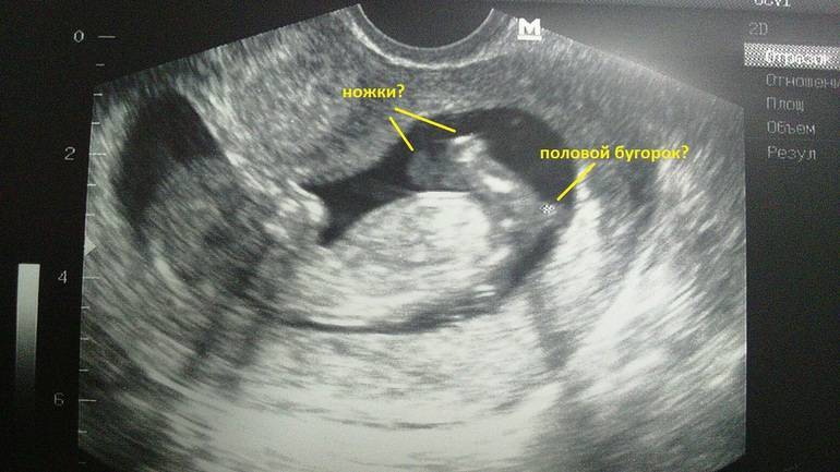 Узи 12 недель беременности мальчик отличие фото