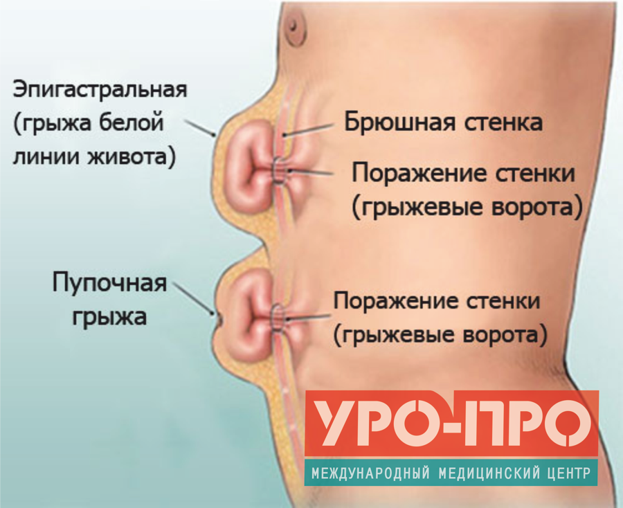 Боли в области пупка у ребенка