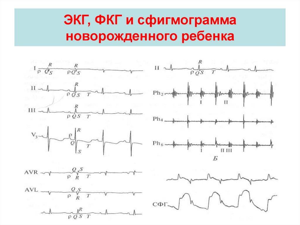 Зачем новорожденным делают кардиограмму, что делать, если у грудничка плохая экг