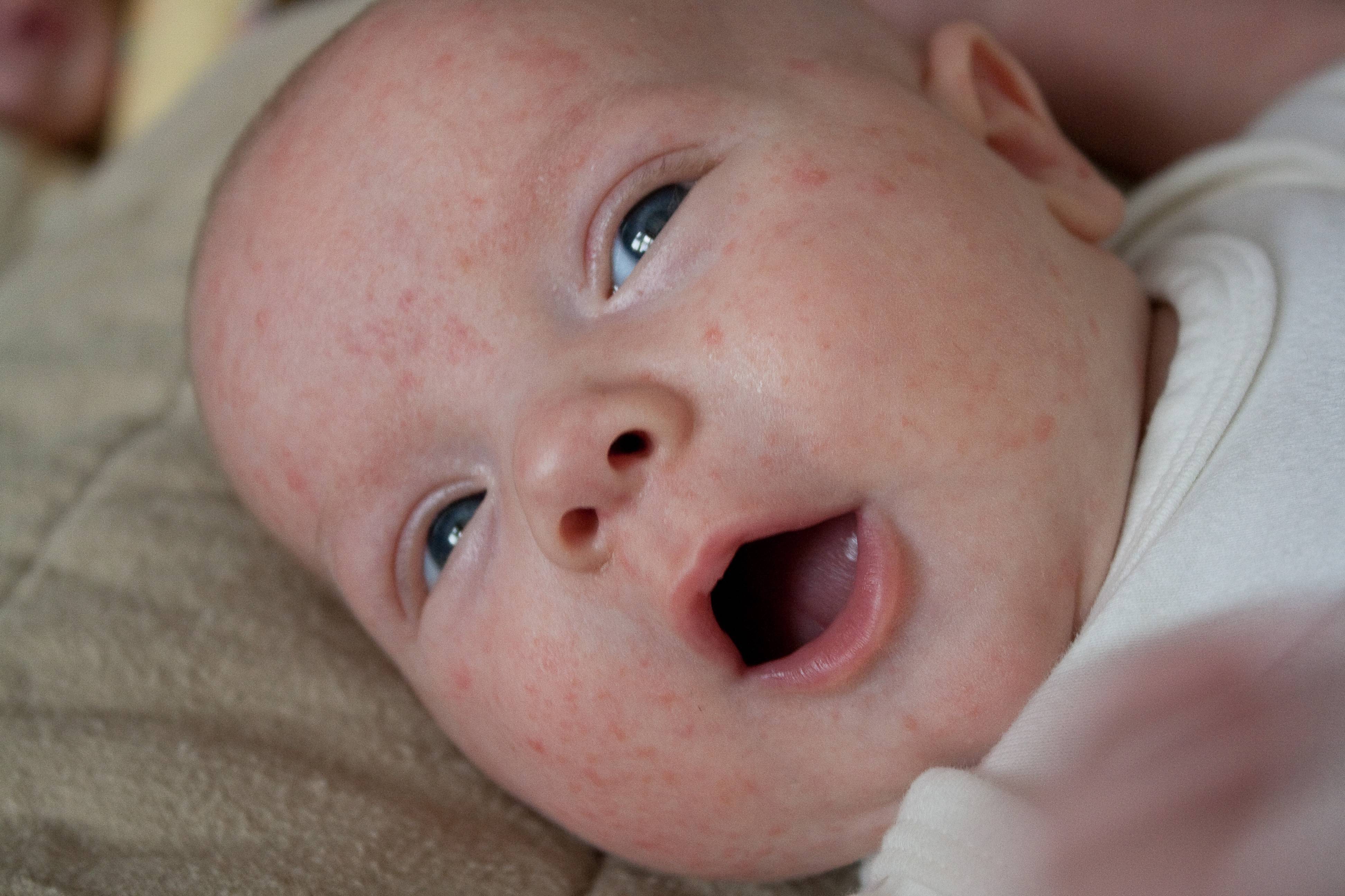 Аллергия у детей – виды, причины, симптомы и эффективное лечение
