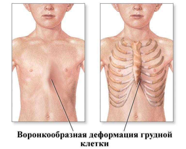Впалая грудная клетка: причины вогнутой груди у мужчин и женщин, ямка в грудной клетке у грудничка, упражнения