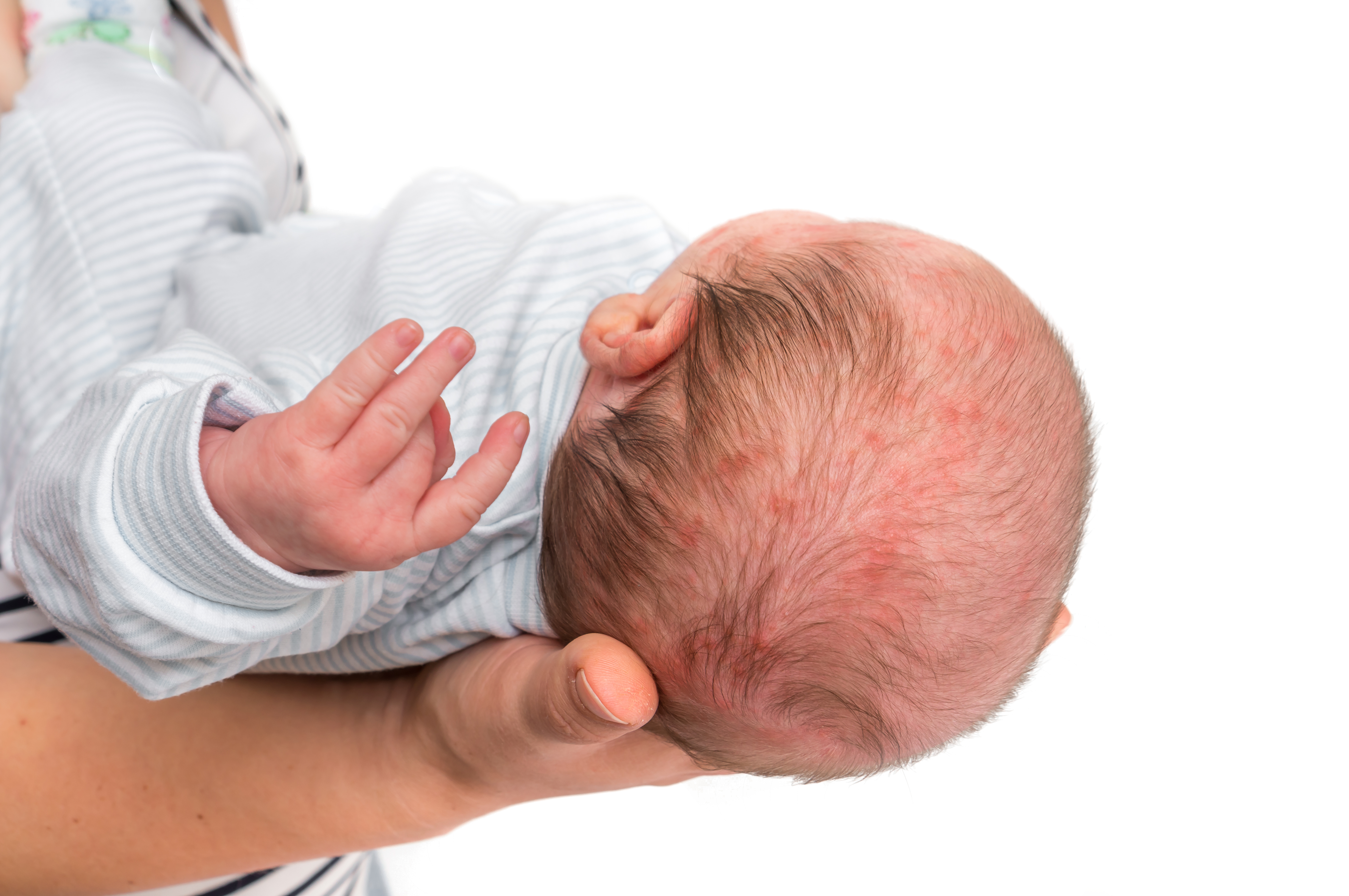 Виды дерматита у грудного ребенка: симптомы и лечение