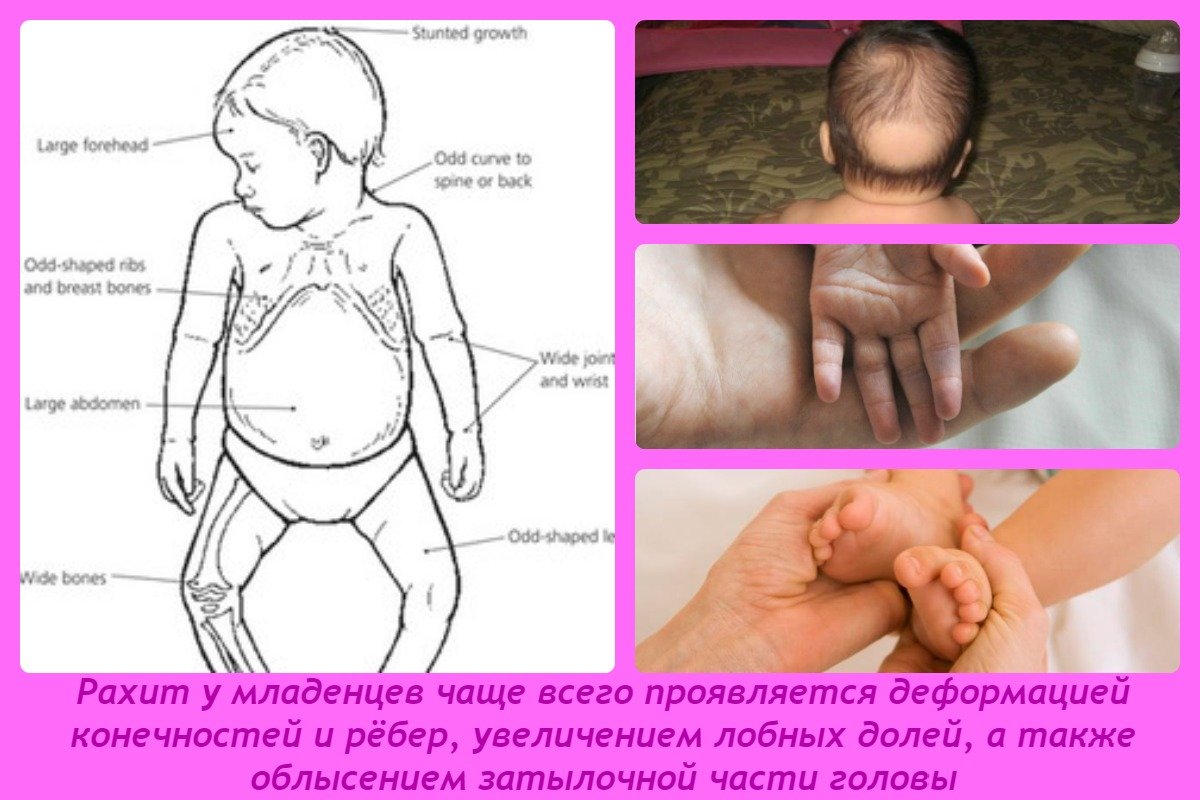 Рахит: признаки, причины, лечение и профилактика / mama66.ru