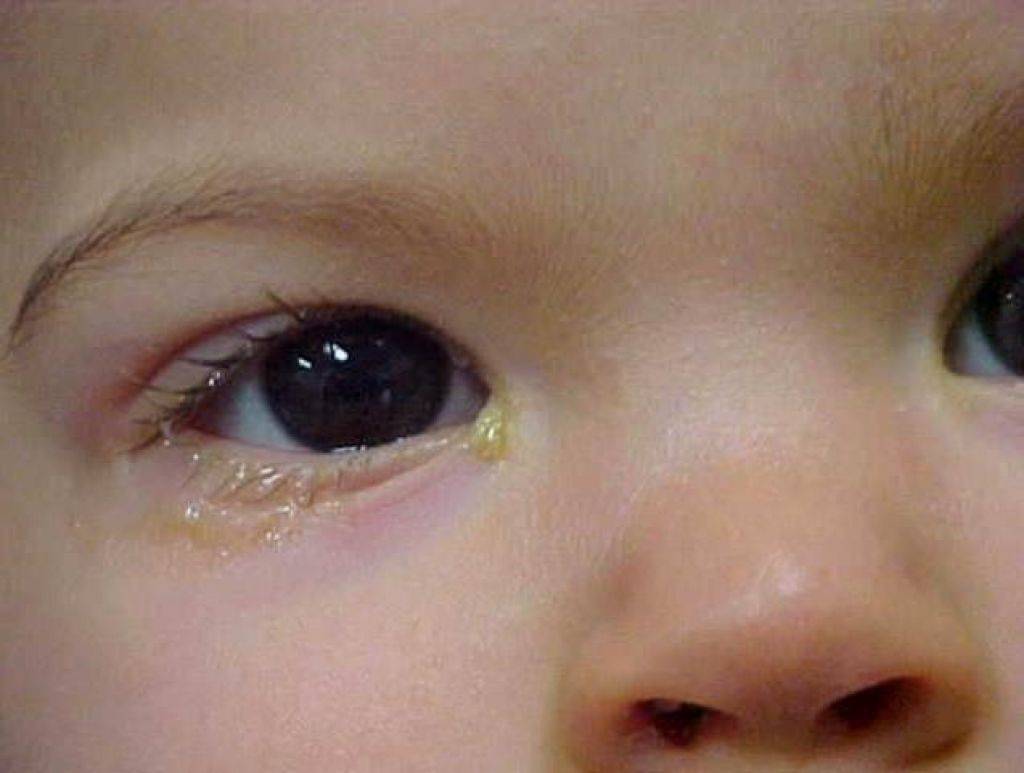 Аллергический конъюнктивит у детей: виды, симптомы и лечение - детский аллерголог см-клиника