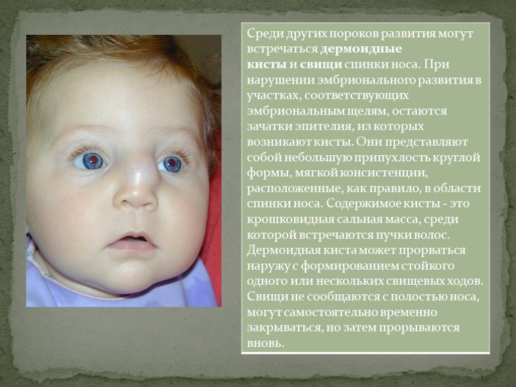 Какой нос будет у ребенка. Дермоидные кисты и свищи спинки носа. Дермоидная киста спинки носа. Пороки развития носа у младенцев. Анамалии развитие носа.