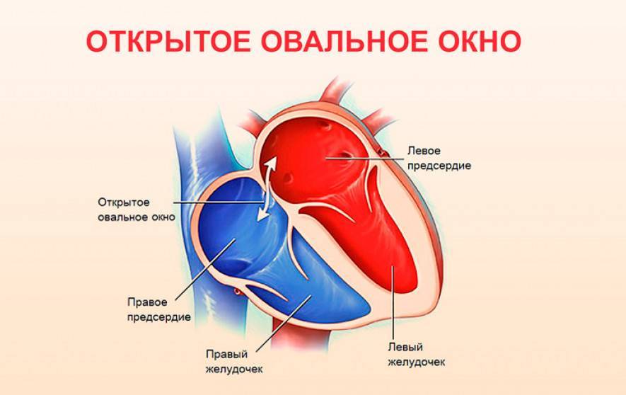 Открытое овальное окно в сердце - симптомы и лечение. журнал медикал