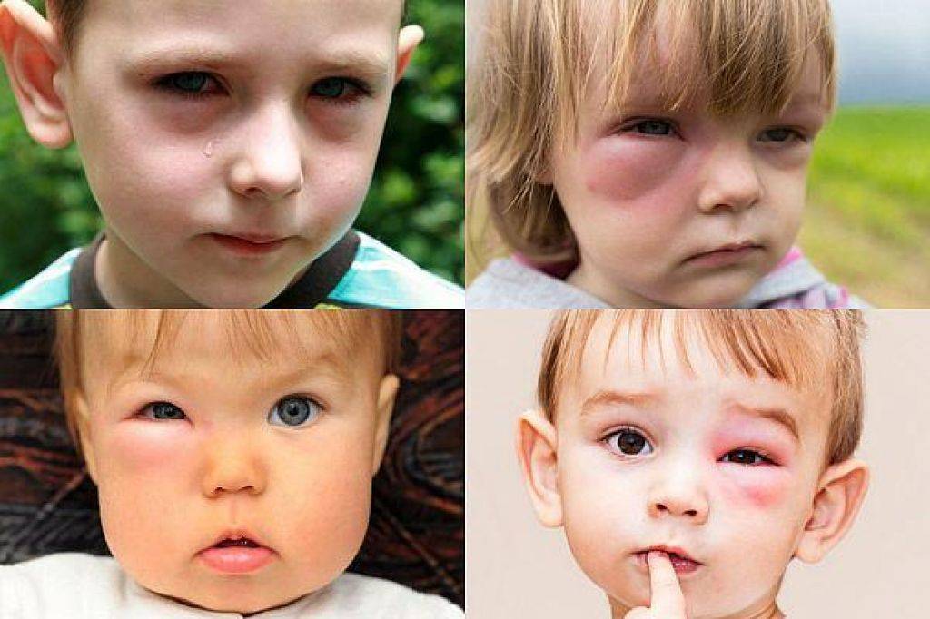 Мешки под глазами у ребенка: красные и синие после сна, причины